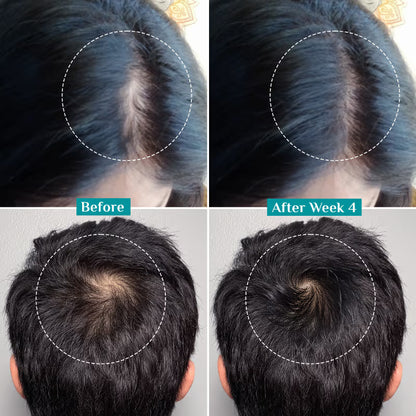 Pilgrim 3% Redensyl 4% Anagain Rosemary Korean Black Rice Hair Growth Serum - 25ml