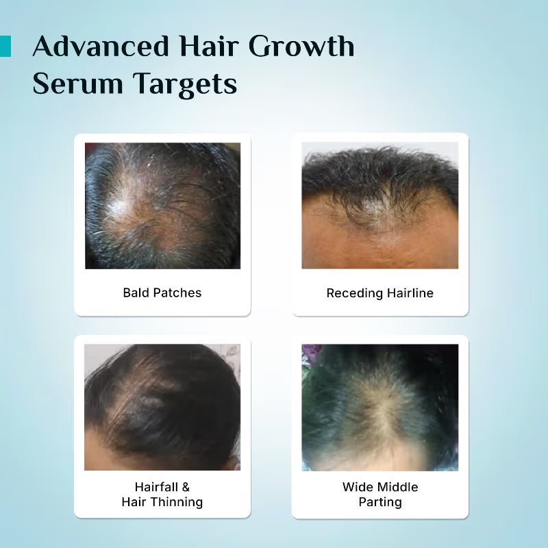 Pilgrim 3% Redensyl 4% Anagain Rosemary Korean Black Rice Hair Growth Serum - 25ml